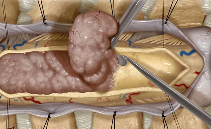 همه چیز درباره جراحی تومور نخاعی : بهترین روش ها و مراقبت های بعد از عمل