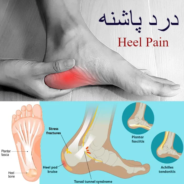 رایج ترین علل درد پاشنه پا و انتخاب بهترین روش درمان